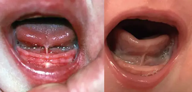 Pediatric Tongue Tie vs Normal Child